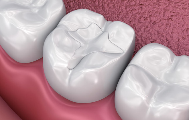 Will Dental Fillings Fall Out