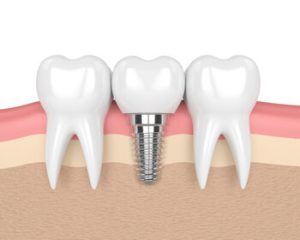 Dental Implant Procedure illustration south plymptom