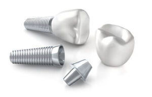 Dental Implant cost parts south plympton