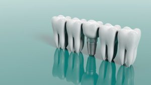 Cost Of Dental Implants In Australia images south plympton