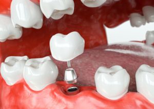 cost of dental implants in Australia placement south plympton