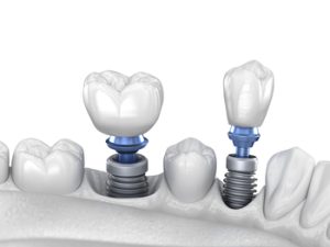  dental implant value south plympton