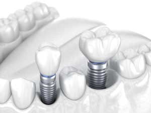 price teeth implant south plympton