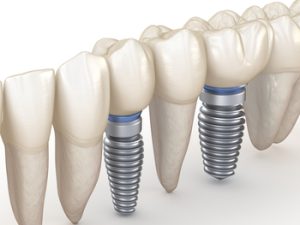 tooth implant expenses south plympton