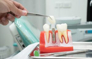 Dental Implant Thailand procedure south plympton