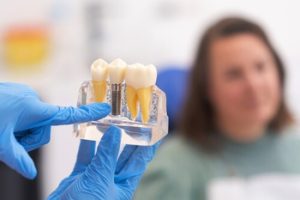 Single Tooth Implant Cost Australia explanation south plympton