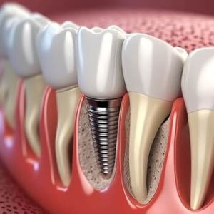 Single Tooth Implant Cost Australia image south plympton