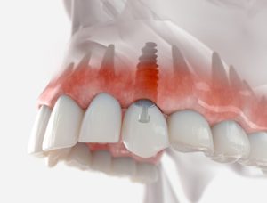 dental implant thailand illustration south plympton