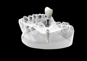 single-tooth-implant-cost-australia-illustration-south-plympton