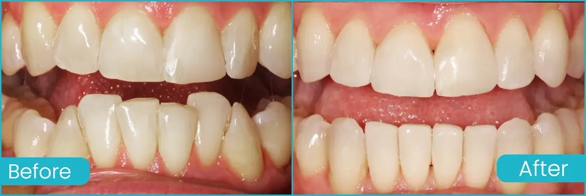 Clear Aligners case 4
