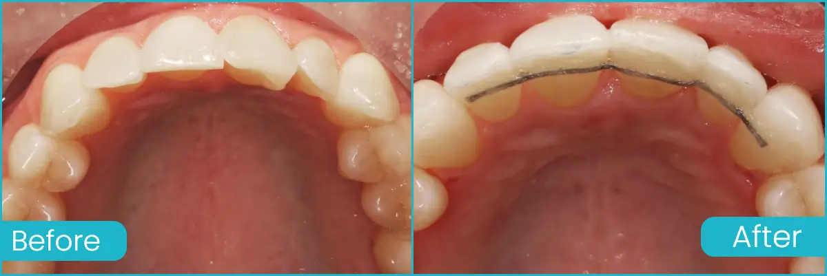 Before and after clear aligners treatment showing improved teeth alignment