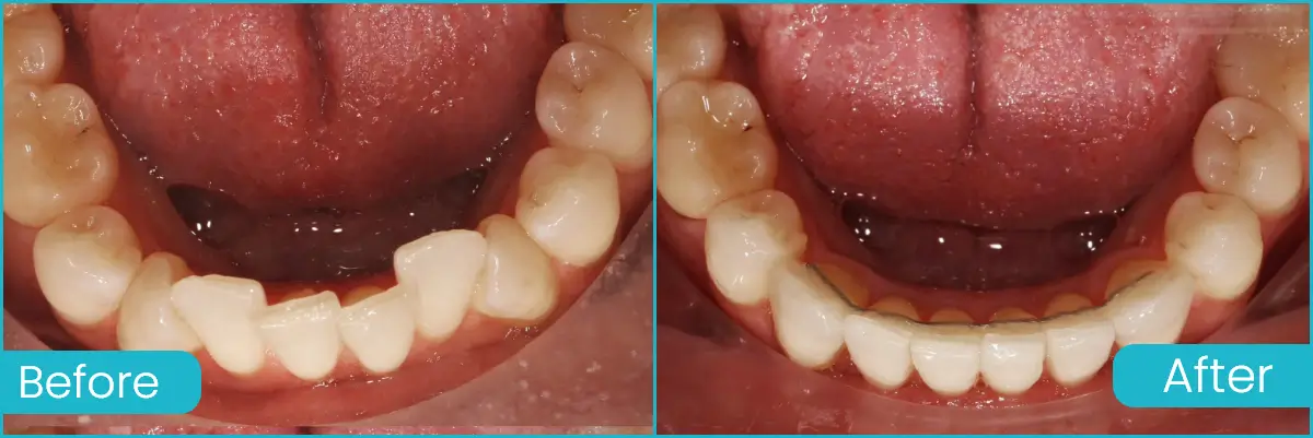 Clear Aligners case 2