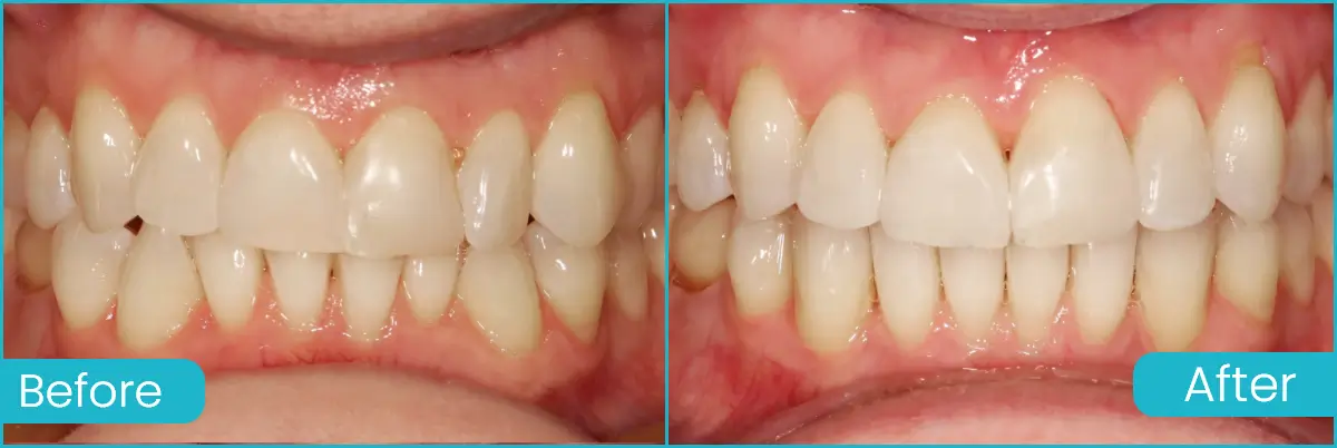 Clear Aligners case 3