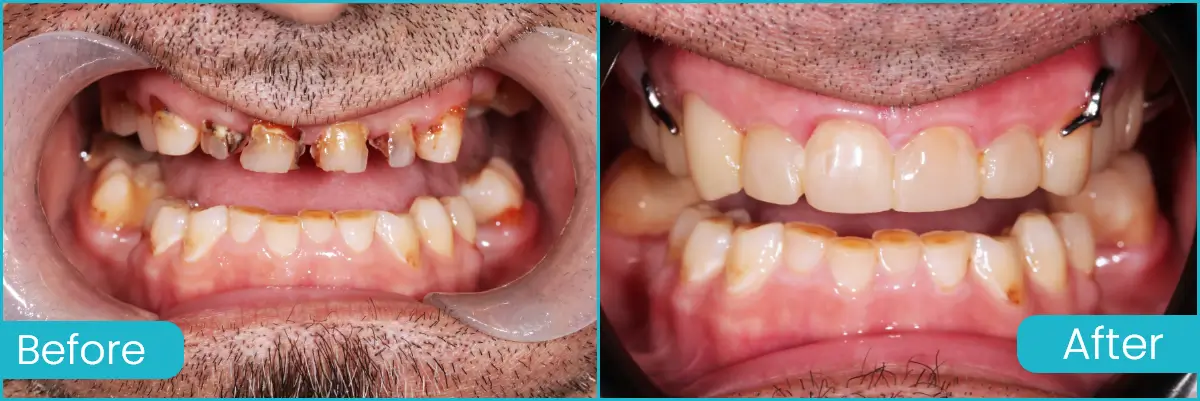 Composite Veneers Case Cross Road Dental 1
