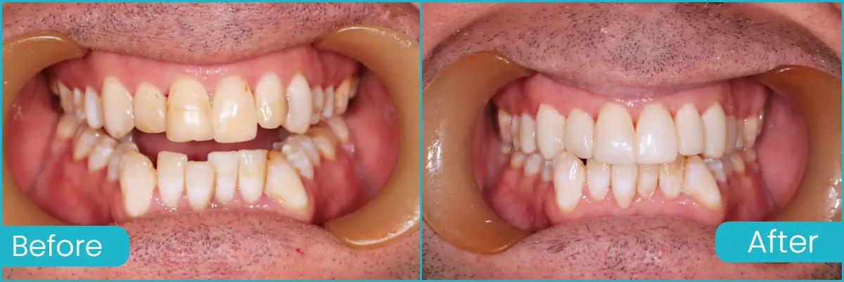 Composite Veneers Case 2 Cross Road Dental