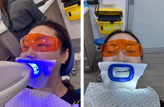 In-Chair Whitening