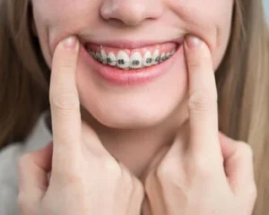 Braces on Crooked Teeth wear