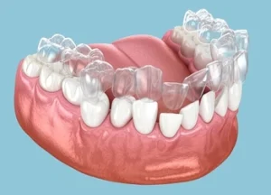 model of mouth being corrected using invisalign