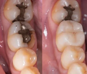 Temporary Tooth Filling replacement
