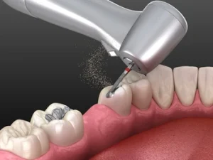 How to Whiten Fillings on Front Teeth replacement