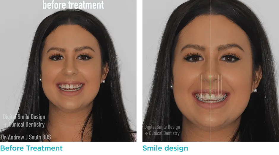pinhole gum surgery