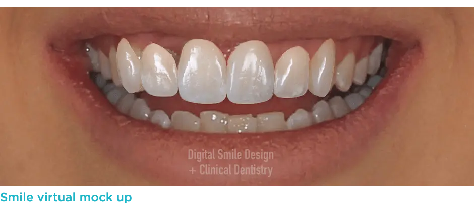 Digital Smile Design