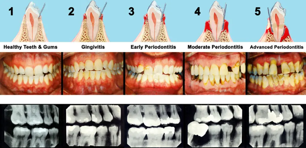 Gum Disease Treatment