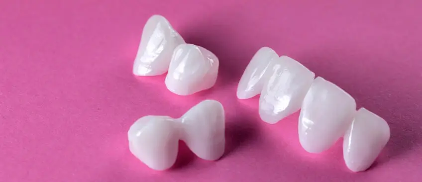 do dental veneers help