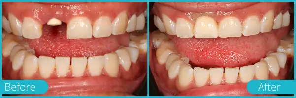 Before and after dental treatment showing closure of a front tooth gap