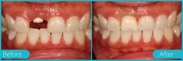Before and after dental treatment showing replacement of a missing front tooth