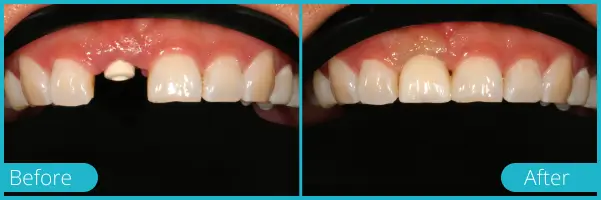 Before and after dental treatment showing restoration of a missing front tooth